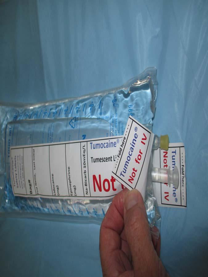 3 Figure S34. Safety labels are applied to both sides of each bag of tumescent lidocaine solution in order to reduce the risk of inadvertent IV delivery.