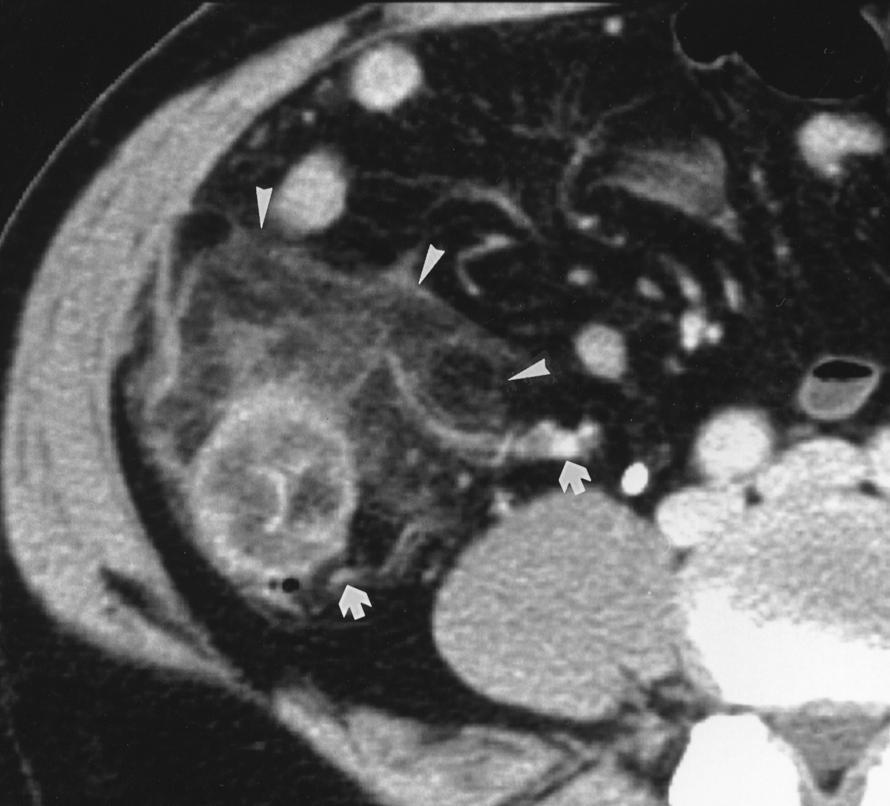 Jang et al. reported to be indistinguishable from carcinoma on CT [5, 22].