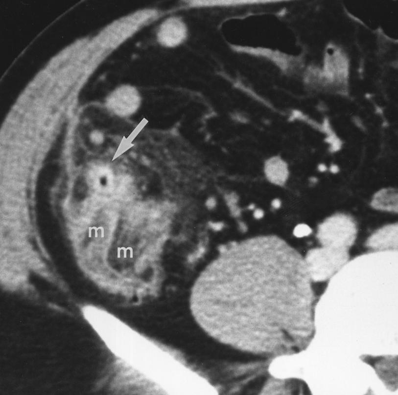 7, 10, 23]. A recent study [24] with helical CT has reported that an arrowhead-shaped wall thickening of the colon is a specific sign of colonic diverticulitis in regions other than the cecum.