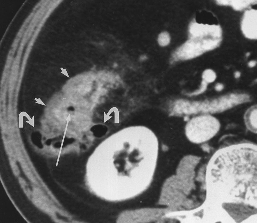 Acute Diverticulitis of the Cecum and Ascending Colon surrounded by the area of peridiverticular inflammation), and preservation of enhancing pattern of the colonic wall [13] (inner high attenuation,