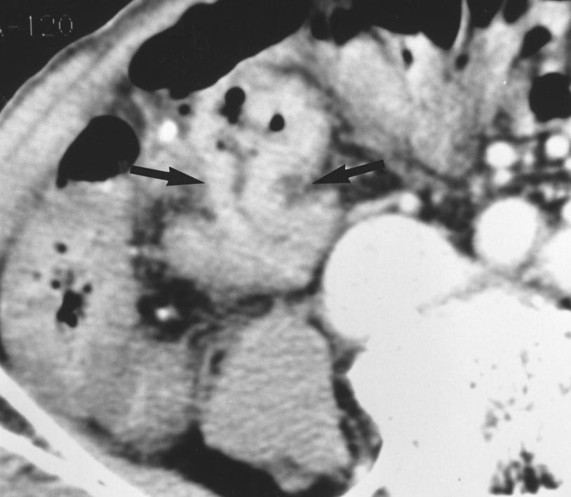 Acute Diverticulitis of the Cecum and Ascending Colon Fig. 7. 56-year-old man with obstructive colitis proximal to colonic carcinoma.