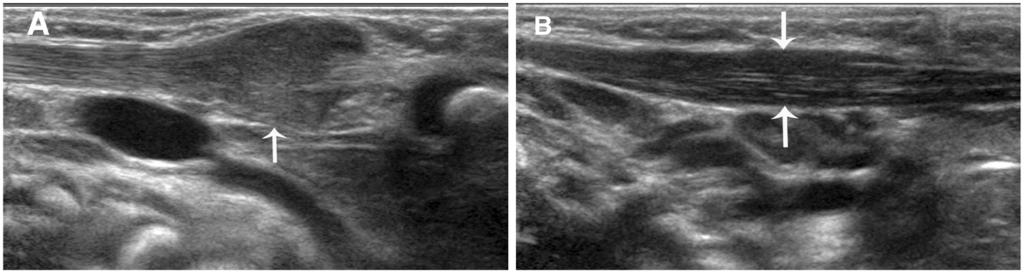 Wang et al. BMC Musculoskeletal Disorders 2012, 13:209 Page 4 of 7 Figure 1 A. A vertical section of the sternocleidomastoid muscle (SCM) in a patient with early-stage muscular torticollis. B. Vertical section of the SCM of the normal side.