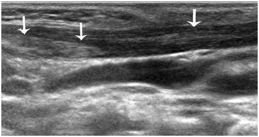 Wang et al. BMC Musculoskeletal Disorders 2012, 13:209 Page 6 of 7 Figure 5 Vertical section of the sternocleidomastoid muscle (SCM) in a patient with late-stage muscular torticollis.