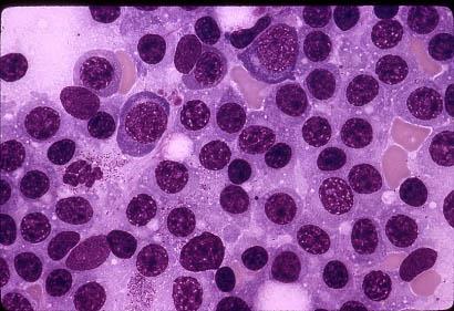 Lymphoplasmacytic (LPL) cells Aspirate from a patient with WM demonstrating excess