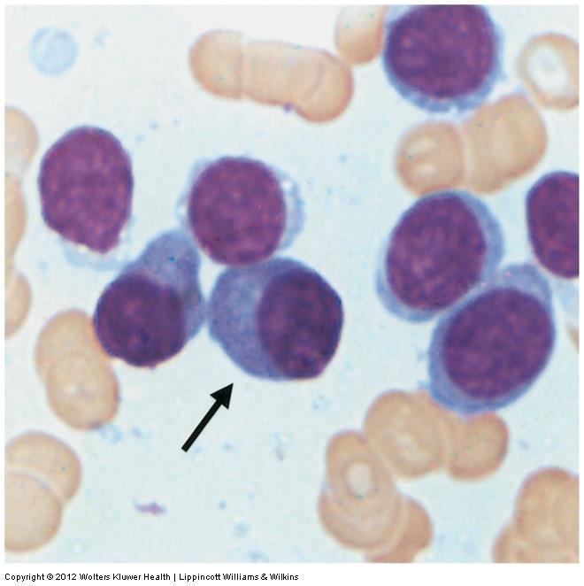 WM: lymphocytes & plasma cells are both present
