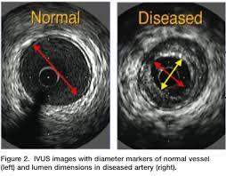 Intravascular Ultrasound (IVUS) +92978 IVUS, initial vessel +92979 IVUS, each additional vessel Use 26 modifier if in hospital/facility 11 FFR/CFR/IFR Data have conclusively shown that physiologic