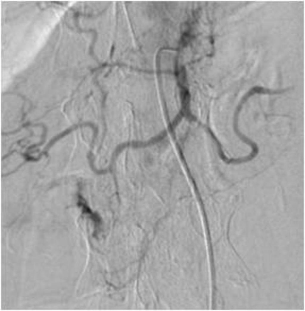 Fig. 29: Coeliac angiography showing