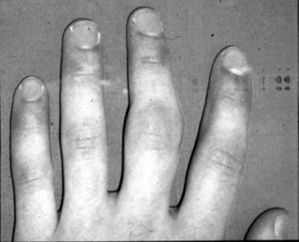 Presentation Swelling of the finger Pain over the dorsal