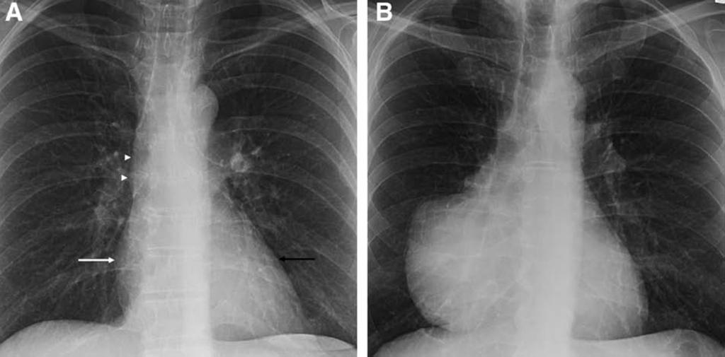 Journal of Thoracic Oncology Volume 9, Number 9, Supplement 2, September 2014 AnteriorMediastinalMass:RadiographicApproach Malignant teratomas, which are residual lesions after treatment of NSGCTs,