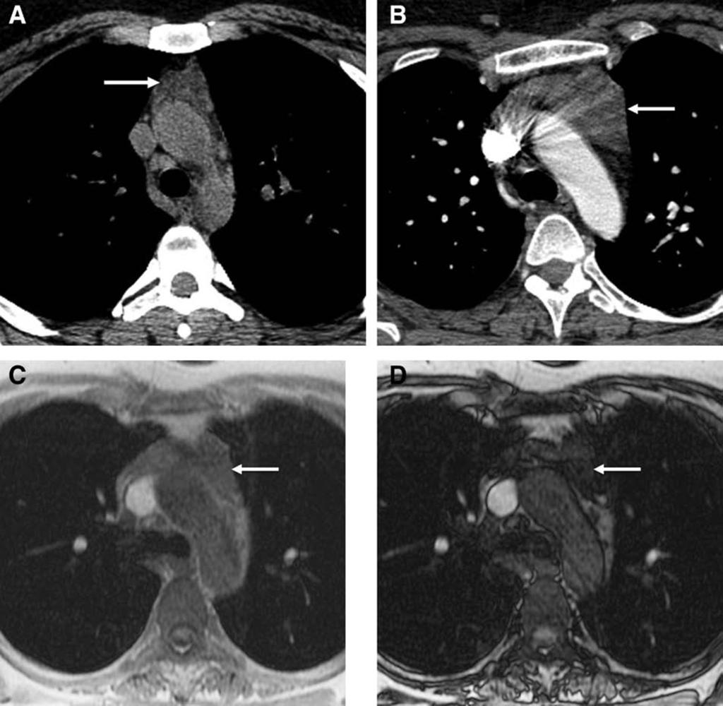 Journal of Thoracic Oncology Volume 9, Number 9, Supplement 2, September 2014 AnteriorMediastinalMass:RadiographicApproach FIGURE 4. Thymic hyperplasia.