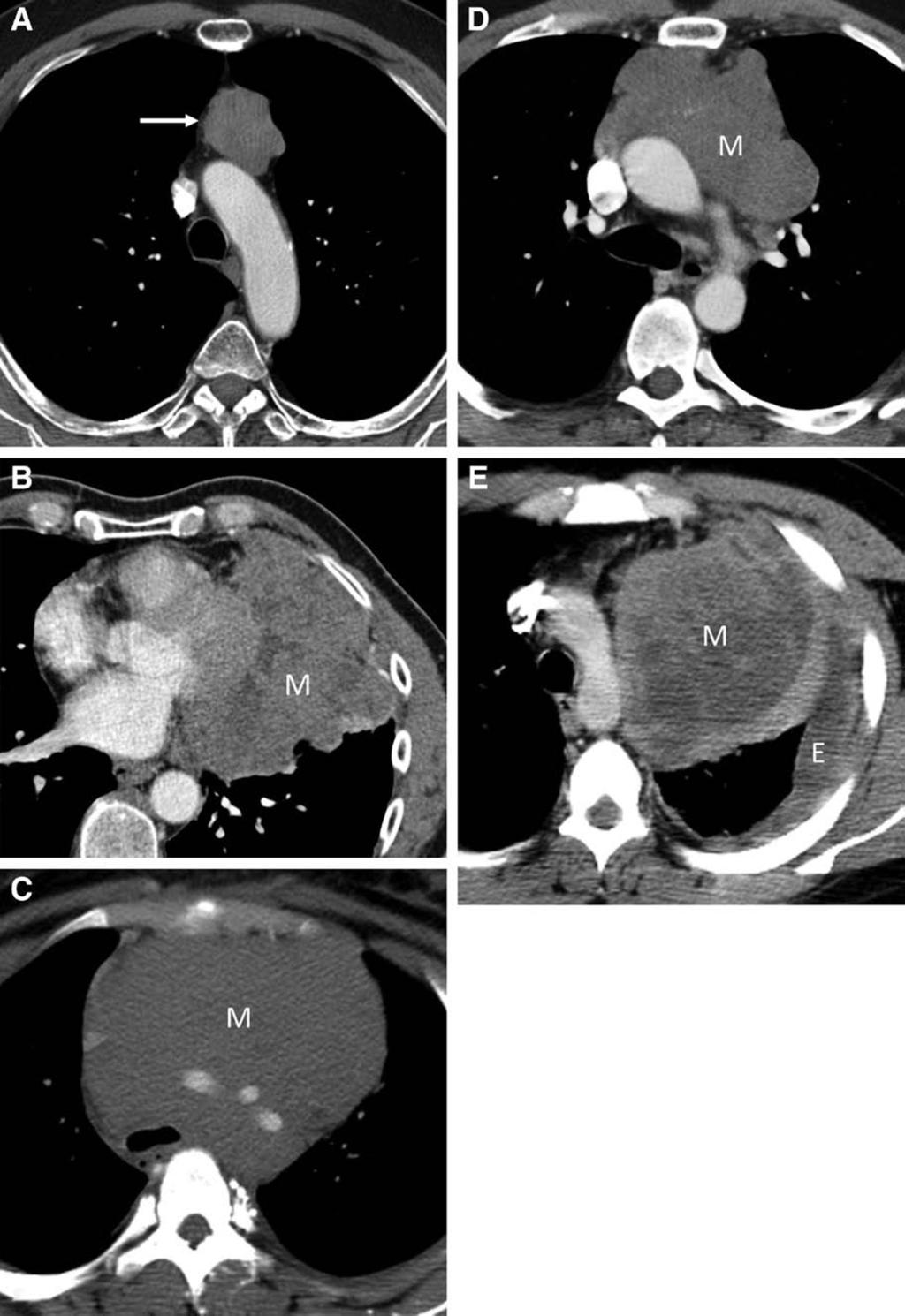 Carter et al. Journal of Thoracic Oncology Volume 9, Number 9, Supplement 2, September 2014 FIGURE 5. Lesions identifiable on imaging with clinical context.