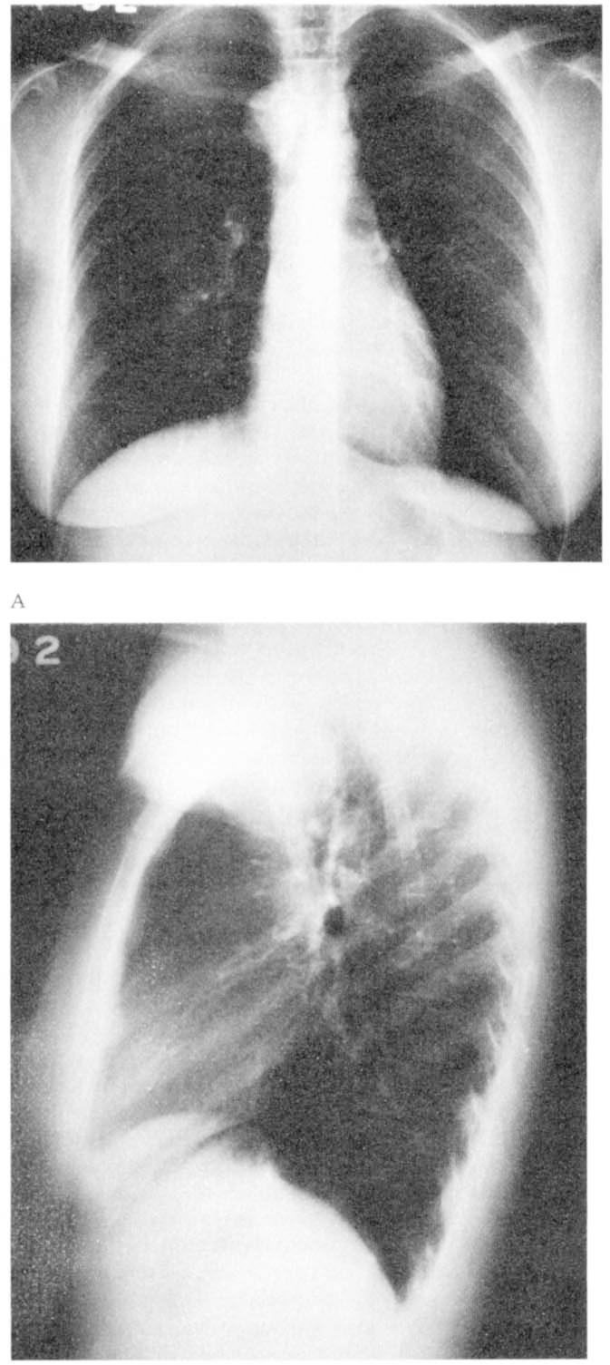 94 KEIWETAL THORACOSCOPY FOR MEDlAbTINAL MASSES Ann Thorac Surg 1993;56:924 underwent routine chest radiography as part of a preoperative evaluation before a gynecologic procedure.