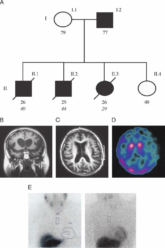 Clarimón et al J Neuropathol Exp Neurol Volume 68, Number 1, January 2009 The present study describes the clinical characteristics of a family comprising 3 siblings who died from very early-onset LBD.