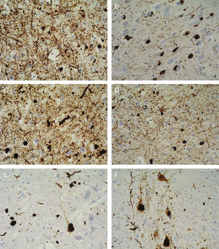 J Neuropathol Exp Neurol Volume 68, Number 1, January 2009 Familial Lewy Body Dementia With Tauopathy TABLE.
