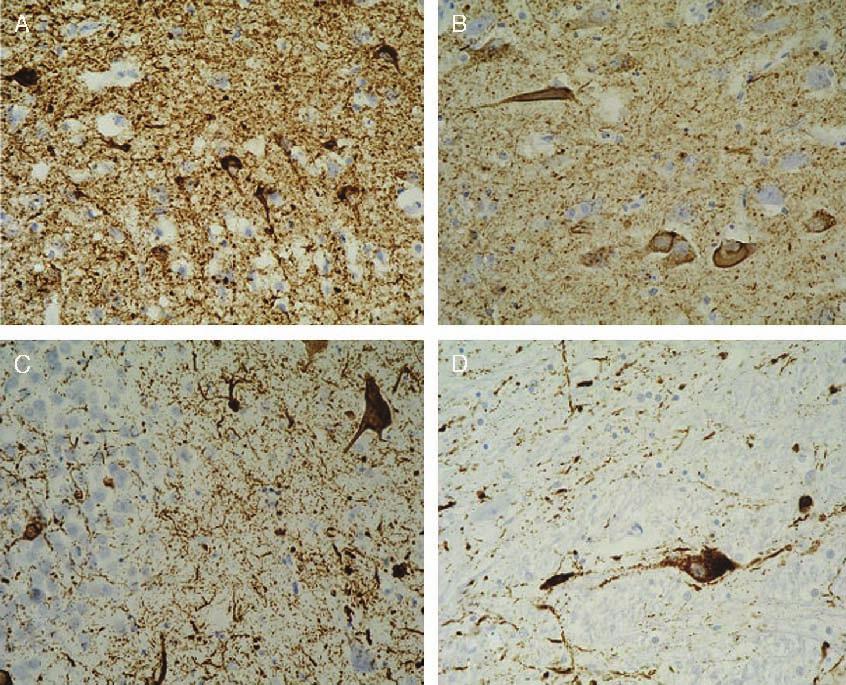 J Neuropathol Exp Neurol Volume 68, Number 1, January 2009 Familial Lewy Body Dementia With Tauopathy anti<a-amyloid (DAKO) at a dilution of 1:50.