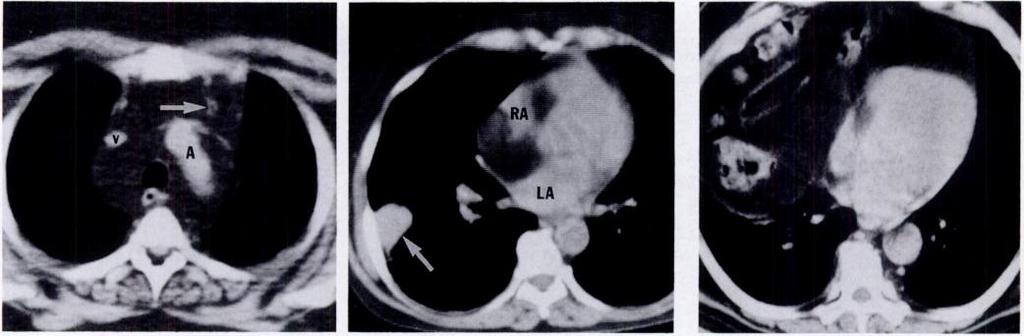 V ii8i CT of Fatty Thoracic Masses -.-. Fig. 1.-Mediastinal lipomatosis. A, CT scan shows abundant fat throughout superior mediastinum.
