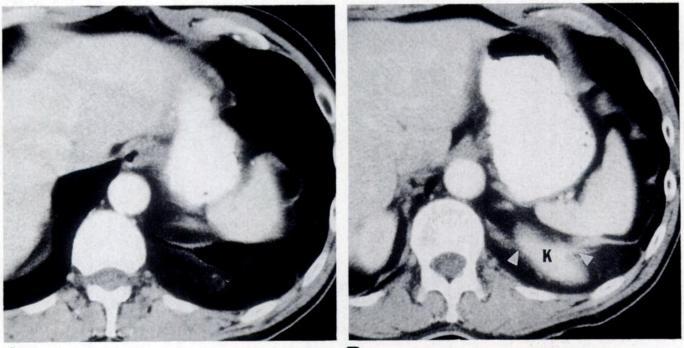 atrioventricular grooves (Fig. 1). Associated extrapleural fat also may be present. Usually no compression of adjacent structures occurs.