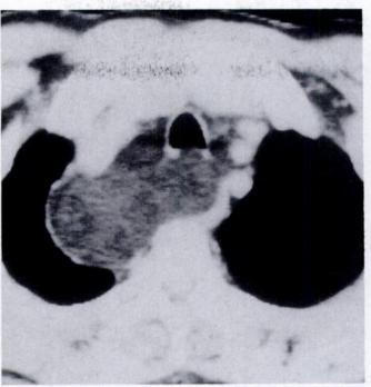 AJR:159, December 1992 CT OF FATTY THORACIC MASSES 1183 Fig. 6.-Esophageal lipoma. CT scan shows homogeneous fatty mass (arrow) in right lateral wall of barium-filled esophagus (E).