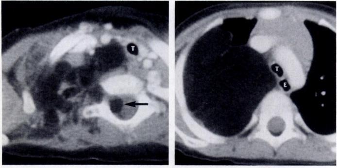 1184 GLAZER ET AL. AJR:159, December 1992 Fig. 10.-Lipoblastoma.