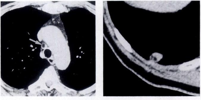 CT scan of 2-mm-thick section section shows a smooth 1-cm pulmonary nodule shows fat (arrow) within a 1-cm pretracheal containing fat. lymph node. Fig. 1 1.