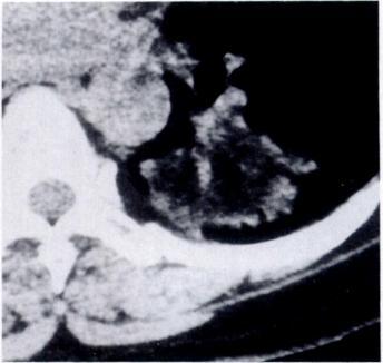 A, CT scan through lower thorax shows bilatoral paraspinal masses with soft-tissue attenuation.