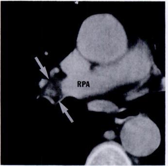 The CT finding that is suggestive of this lesion is a smooth pulmonary nodule 2.5 cm or less in diameter that contains focal collections of fat or fat alternating with areas of calcification [4] (Fig.