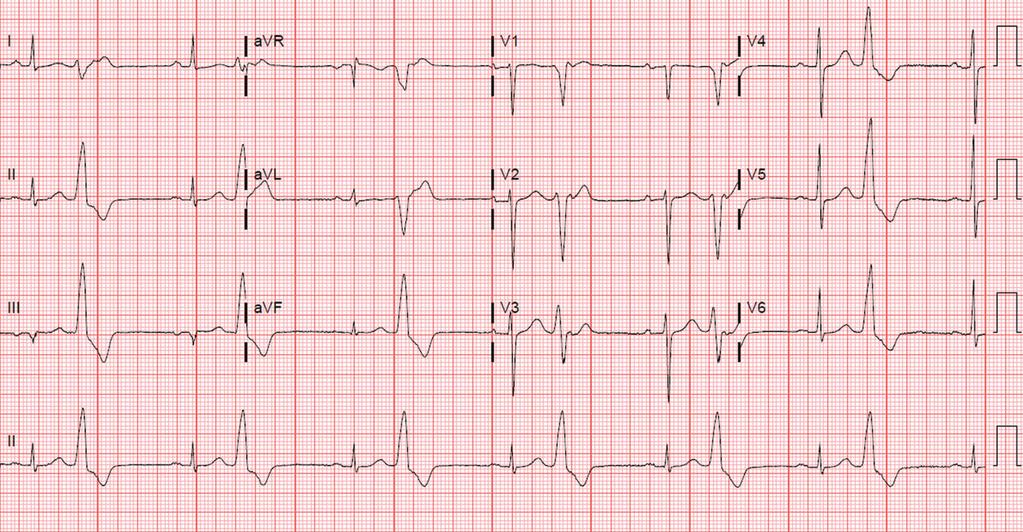 Figure 1. A 12-lead ECG shows LBBB morphology PVCs with inferior axis in bigeminy pattern.
