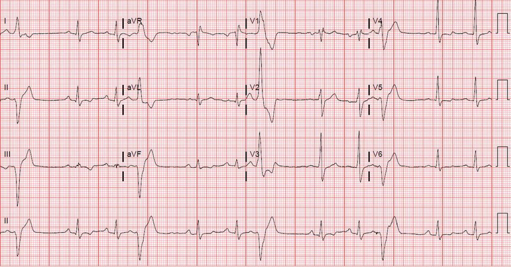 A 12-lead ECG shows RBBB morphology PVCs with superior axis in trigeminy pattern. Abbreviations: ECG, electrocardiogram; PVCs, premature ventricular contractions; RBBB, right bundle branch block.