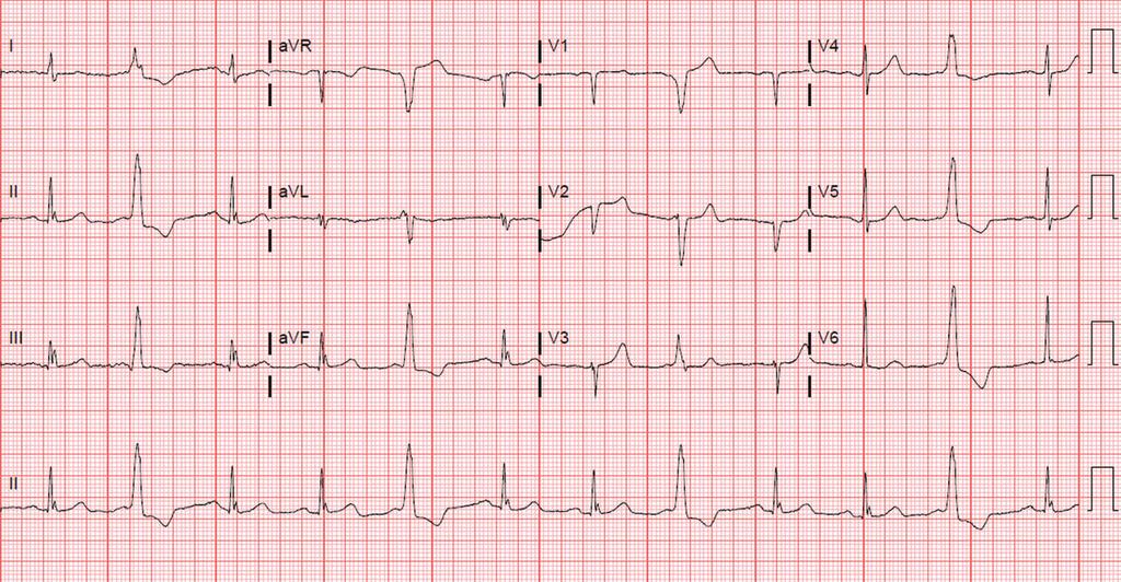 Figure 3. A 12-lead ECG shows sinus rhythm with interpolated PVCs in trigeminy pattern. Note that there is no compensatory pause after the interpolated PVCs.