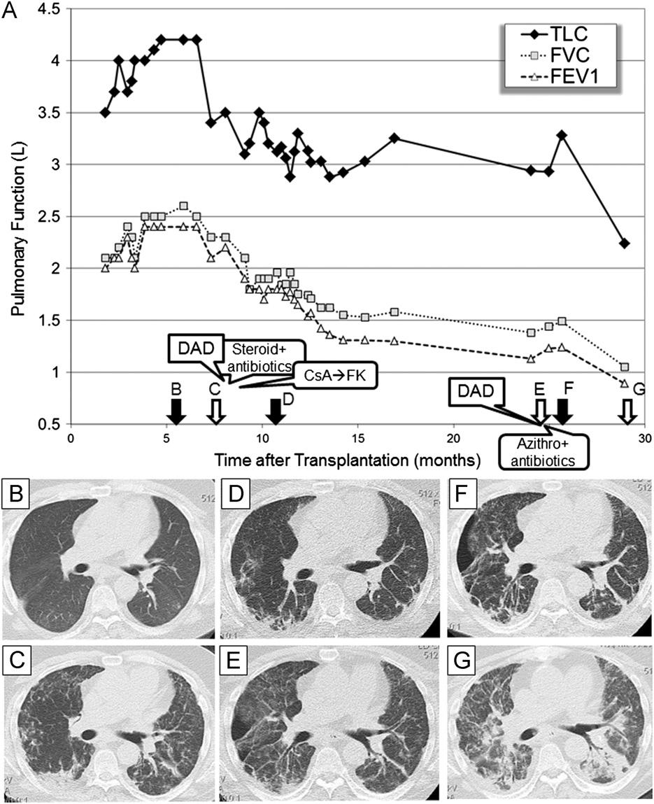 Sato et al. RAS Progression Pattern 27 Figure 4 A representative case of RAS after lung transplantation: Case 1.