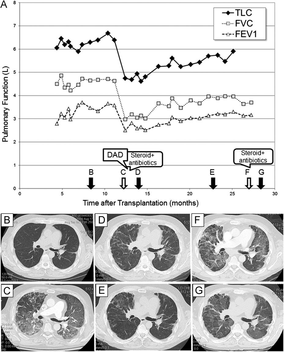 Sato et al. RAS Progression Pattern 29 Figure 6 Representative case of RAS after lung transplantation: Case 3.