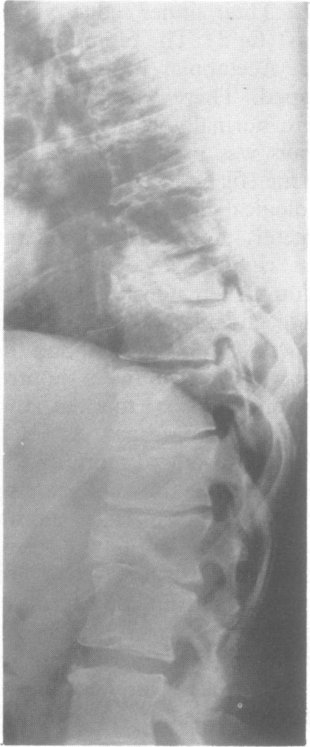 470 qk ag Figure 8 Patient 2 at 43 years. Wedge shaped vertebral bodies, narrow medullary canal, and spondylarthrosis. Figure 9 Patient 2 at 43years. Note insufficient interpedicular distance.