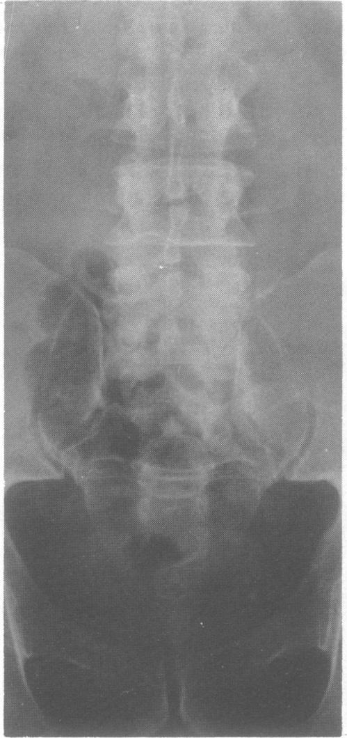 Recently, light perception has been improved by partial lens dislocation. When we saw him at the age of 41, he was 139 cm tall, with micromelia and a shortened, bell shaped thorax.