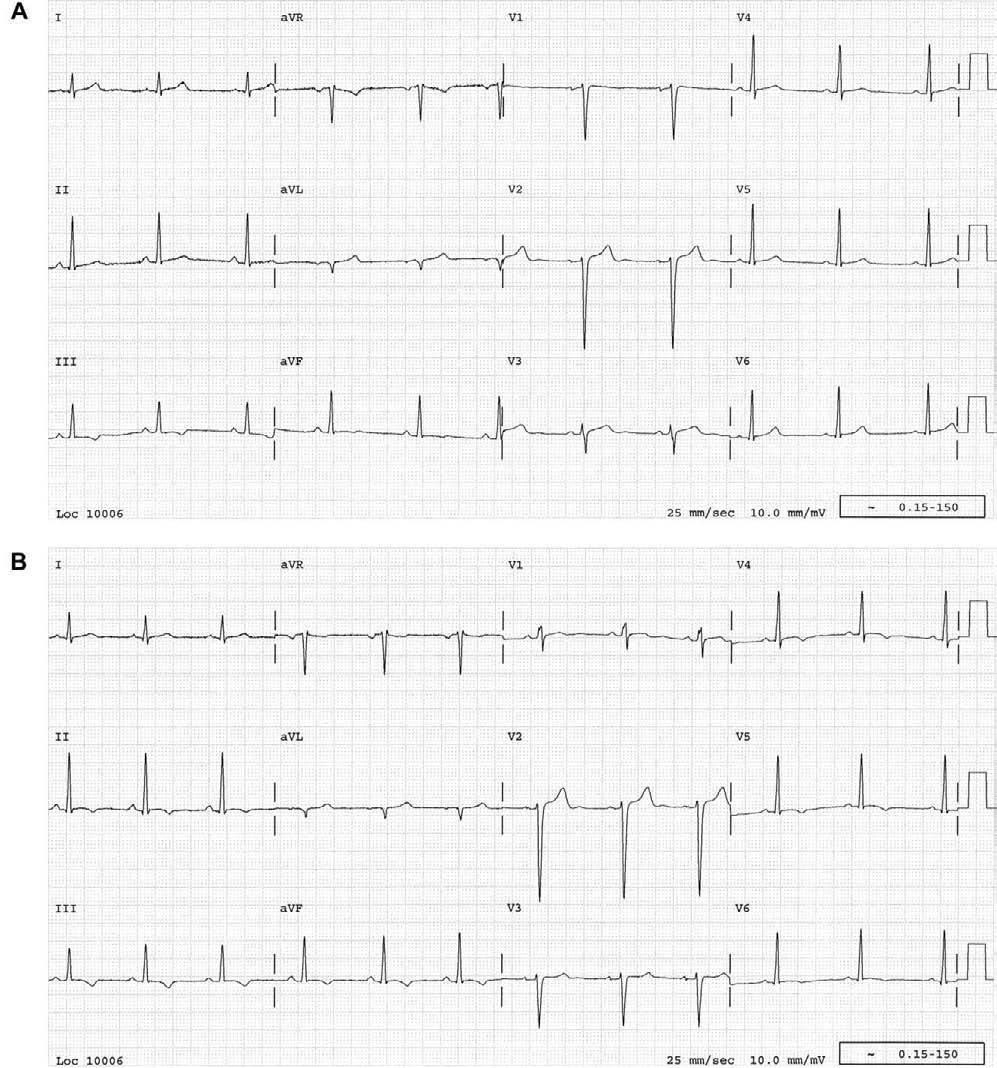 Figure 1. Serial electrocardiograms (ECGs) for the case patient. A, Baseline ECG. B, ECG obtained during influenza infection showing new T wave inversions and changes in V1.