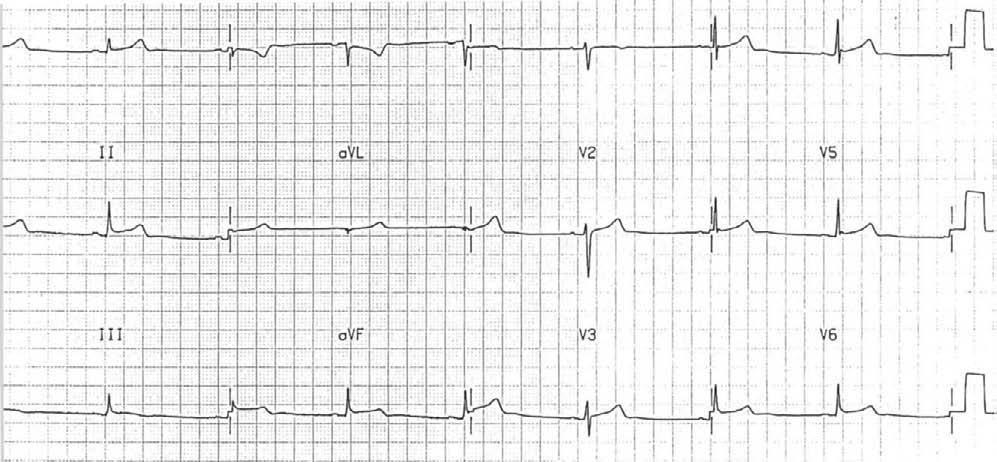 Figure 3. Example electrocardiogram for the patient who had persistent ST-segment elevations normal ECG findings during the early stage of illness.