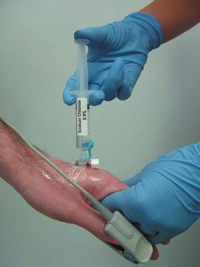 Principles and practice of intravenous sedation 115 Figure 7.8 The position of the cannula is checked by injecting 2ml of 0.9% saline.