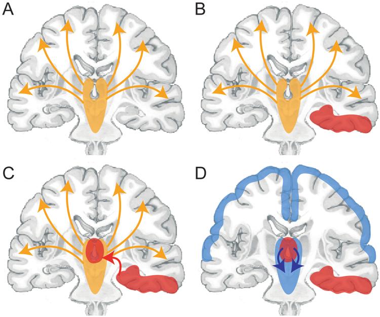 DBS for consciousness in patients with epilepsy Fig. 1. Network inhibition hypothesis for loss of consciousness in patients during partial seizures. A: Normal conditions.