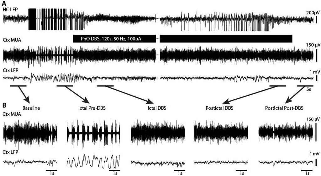 Kundishora 39 Figure 2. Cortical physiological arousal with PnO DBS in a focal limbic seizure.