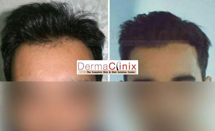 Hair Transplant in Chennai- Things You Need to Know Our world is changing every day; the increasing pollution rates and industrialization are directly affecting our health and giving rise to various