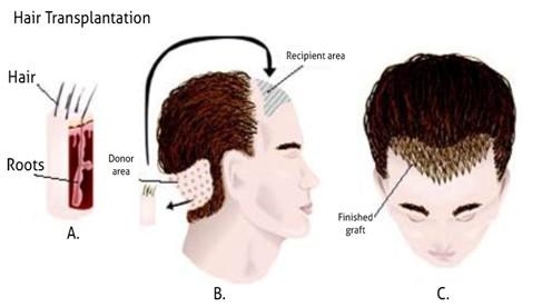In strip harvesting, a region with optimum hair growth is searched from different parts of the body.