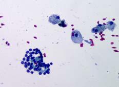 Case 2: 37 yo woman with right thyroid nodule Cytology Molecular Histology MUT WT FINAL DIAGNOSIS: FNA RIGHT THYROID: LESION OF UNDETERMINED SIGNIFICANCE.