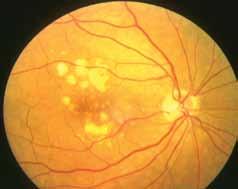 CET CONTINUING Sponsored by 1 CET POINT 52 Risk factors for AMD AMD is a complex disease caused by the combination of genetic predisposition 7,8 (involving multiple causative genes) and environmental