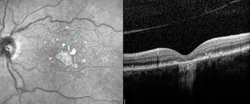 Sponsored by Figure 2 Spectralis OCT showing dry atrophic AMD macular changes.