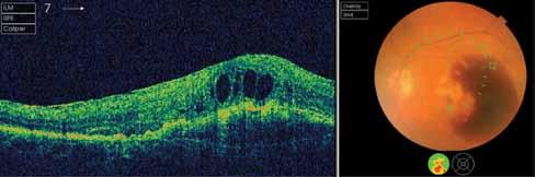 1 CET POINT CET CONTINUING 54 Figure 4 Topcon OCT demonstrating intra-retinal fluid associated with a large macular haemorrhage in wet AMD Figure 5 (a) Spectralis OCT showing intra-retinal (IRF) and