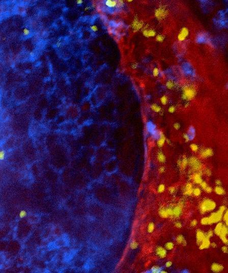 respectively identify the stroma (red) and the tumor epithelial cell regions (blue).