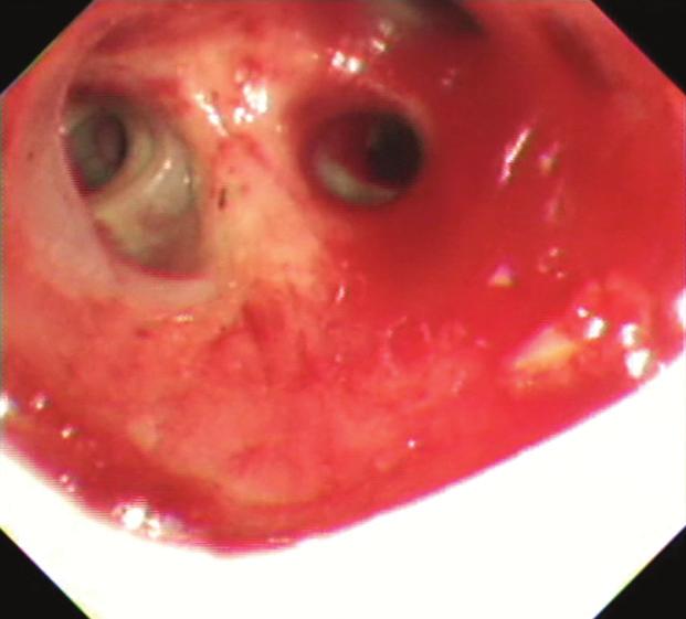 The patient also developed the obstruction at the peripheral end of the Y-stent due to granulation tissue formation that required bronchoscopic resection using argon plasma coagulation 7 weeks after