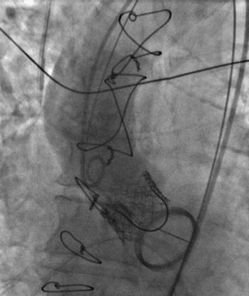 44 M. Bunc et al. Fig 3. Aortic angiography after successful implantation of Edwards-Sapien valve.