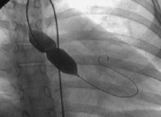 Aortic Balloon Valvotomy Palliative option for inoperable patients Percutaneous approach to decrease