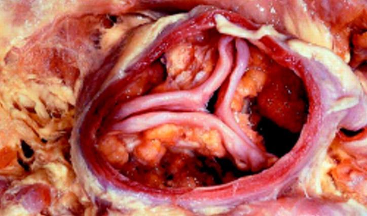 Aortic Stenosis Abnormal narrowing of aortic valve Caused by calcification Bases to