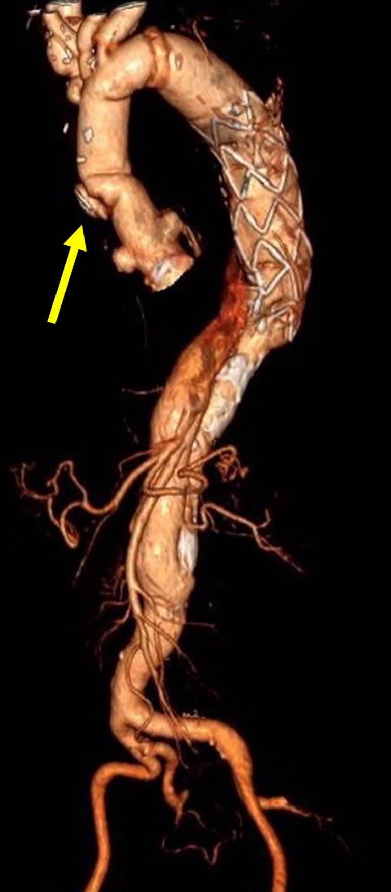 Page 2 of 6 Journal of Visualized Surgery, 2018 Figure 1 Preoperative 3D CT angiogram with the pseudoaneurysm (arrow). CT, computed tomography. graft (JOTEC GmbH, Hechingen, Germany).